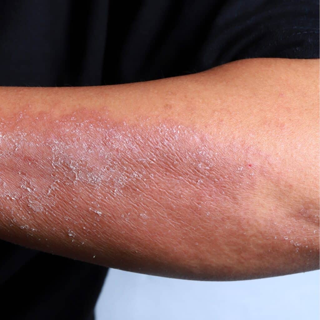 dry and red skin rash