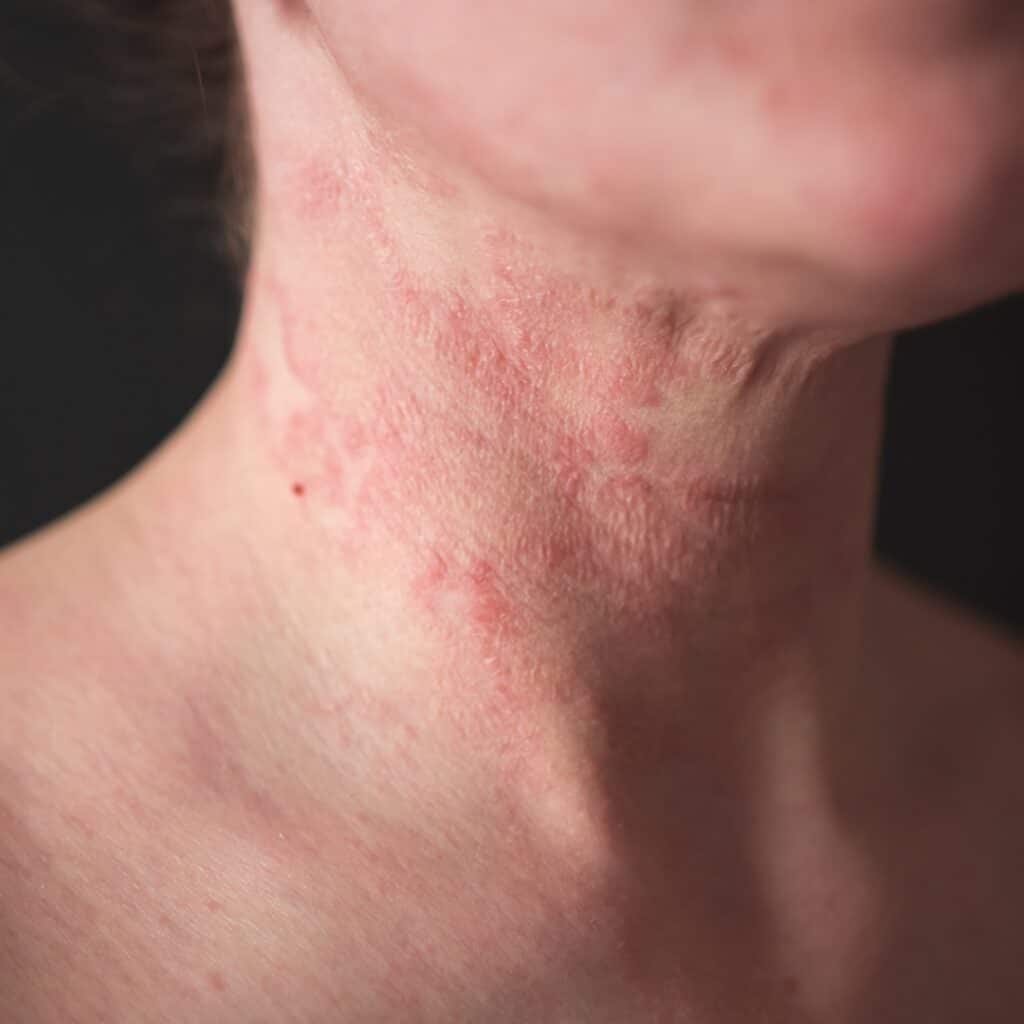 dermatitis on neck