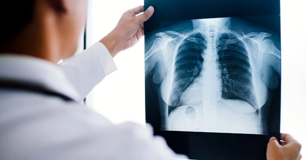 Doctor reviewing a chest X-ray in a medical setting